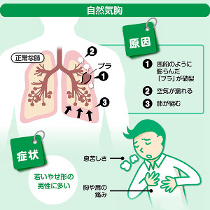 選手生命を脅かすゲームによるケガと病気 その予防法 Esports Esports Doga
